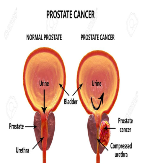 LE CANCER DE LA PROSTATE