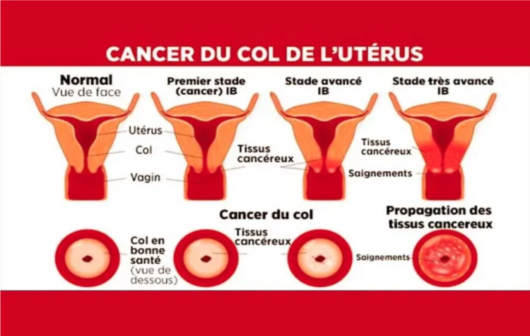 LE CANCER DU COL DE L’UTERUS