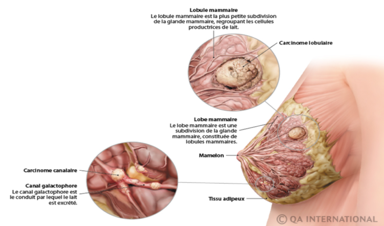 LE CANCER DU SEIN