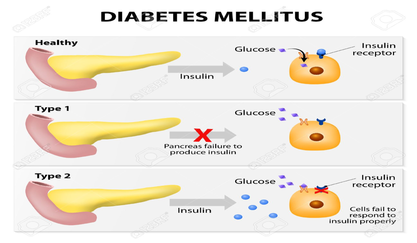 LE DIABETE